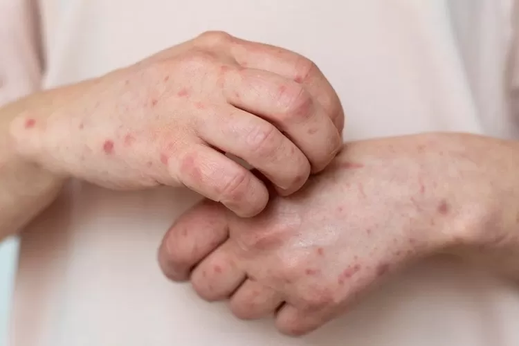 Berikut ini beberapa cara yang bisa dilakukan agar terhindar dari cacar monyet (Freepik)