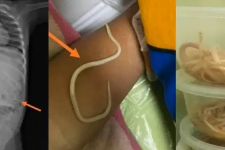 Potret Cacing Pita yang Ada di Perut Anak 3 Tahun. (UM-Surabaya)