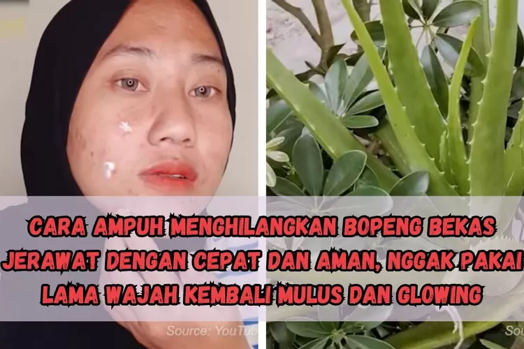 TERBUKTI! Begini Cara Ampuh Menghilangkan Bopeng Bekas Jerawat Dengan ...