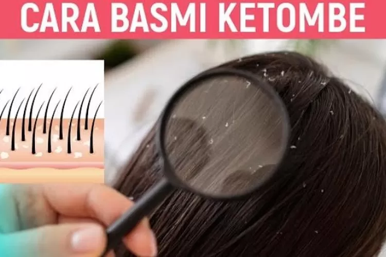 Kulit Kepala Gatal Akibat Ketombe? Tenang, 12 Langkah Ini Akan Membantu!