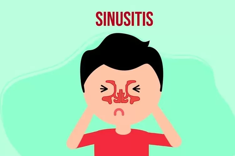 Mengenal Sinusitis: Gejala, Penyebab, Dan Solusi Dari Perspektif Dokter ...