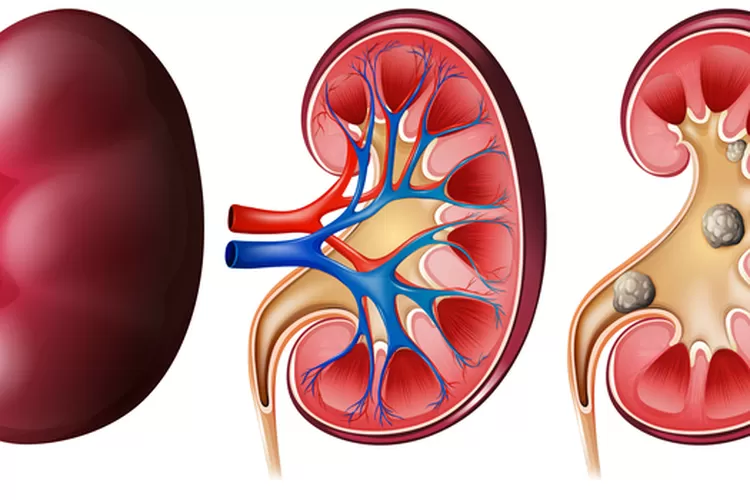 10 Langkah Hebat Mengatasi Penyakit Ginjal: Panduan Lengkap untuk Hidup Sehat
