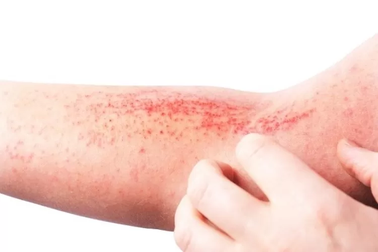 Mengenal Penyakit Dermatitis Gejala Dan Cara Pencegah Vrogue Co