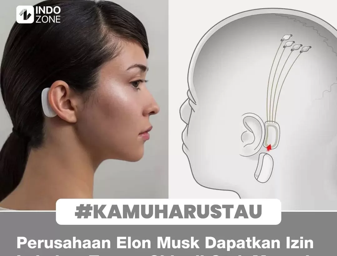 Disetujui FDA, Elon Musk Buka Pendaftaran Untuk Uji Klinis Neuralink ...