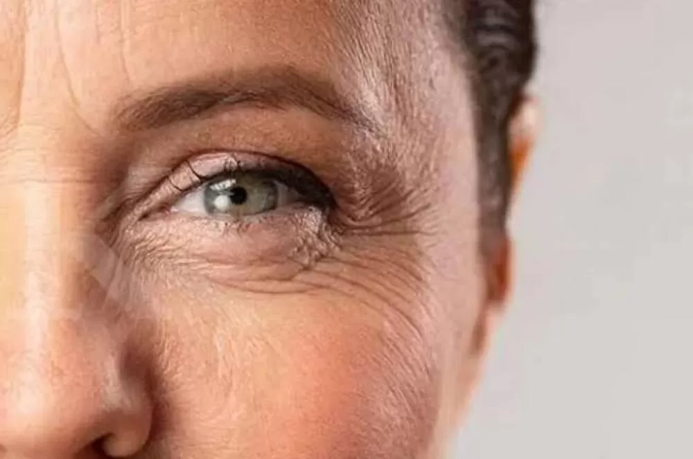 Gambar kulit kriput (Momsmoney)