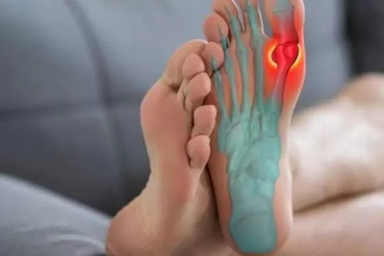 Ini dia faktor risiko penyakit asam urat (Instagram/ @catatan.sidokter )