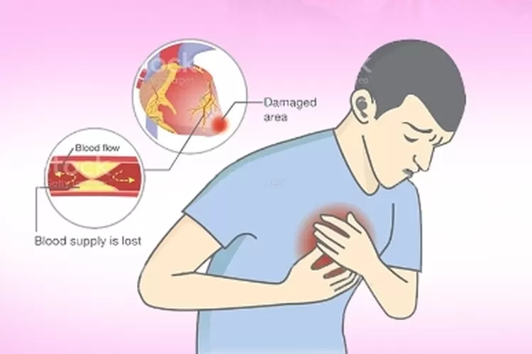 Studi Baru Disebut Bisa Identifikasi Tanda-tanda Serangan Jantung (Ilustrasi Manggarai NewsCom )