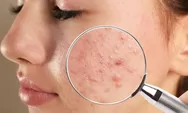 Catat! Ini 15 tips untuk menghilangkan noda bekas jerawat dengan bahan alami, ada dari kentang dan telur