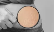 Mengenal Perbedaan Warna Stretch Mark dan Cara Efektif Mengatasinya