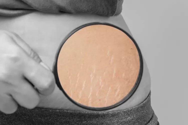 Foto Ilustrasi Stretch Mark. (Tangkap Layar Channel YouTube Heystetik)