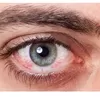 9 Pola Gaya Hidup yang Tidak Sehat Menyebabkan Kerusakan Pada Mata