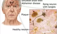 Penelitian di UK Mengungkap Penyakit Alzheimer Dapat Menular Antar Manusia, Berikut Penjelasannya