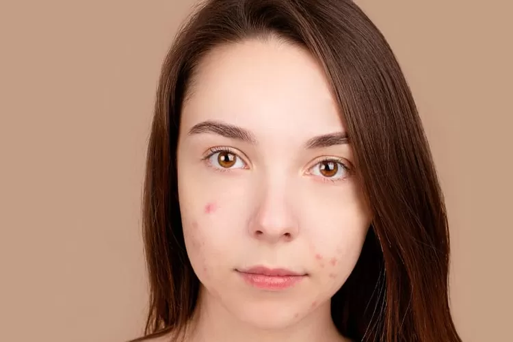Foto ilustrasi jerawat sangat umum terdapat pada remaja (Pexel.com/MetroNTB.com)
